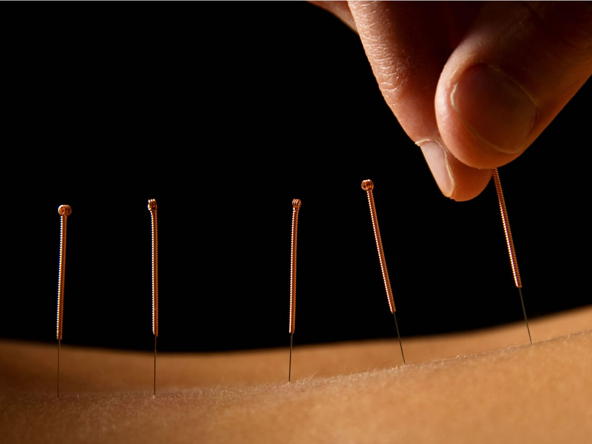 Acupuncture Yields Improved Outcomes in Carpal Tunnel Syndrome
